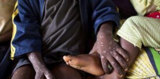 Monkey pox: African countries call for equitable access to vaccine